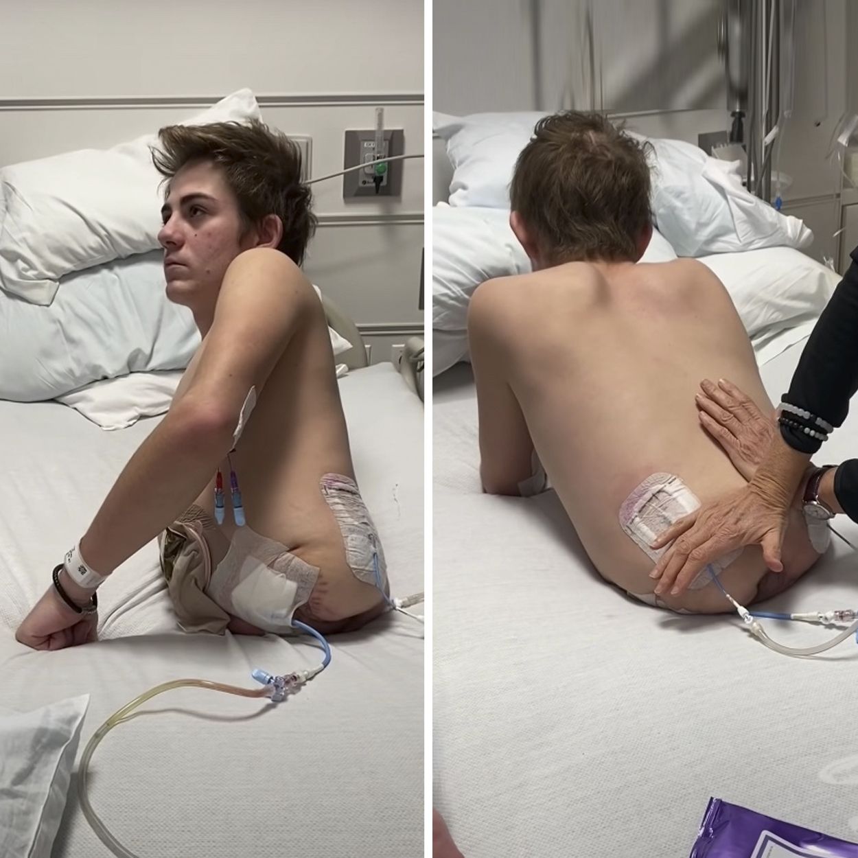 Una historia de superación: seguir viviendo tras quedar partido por la mitad por un accidente