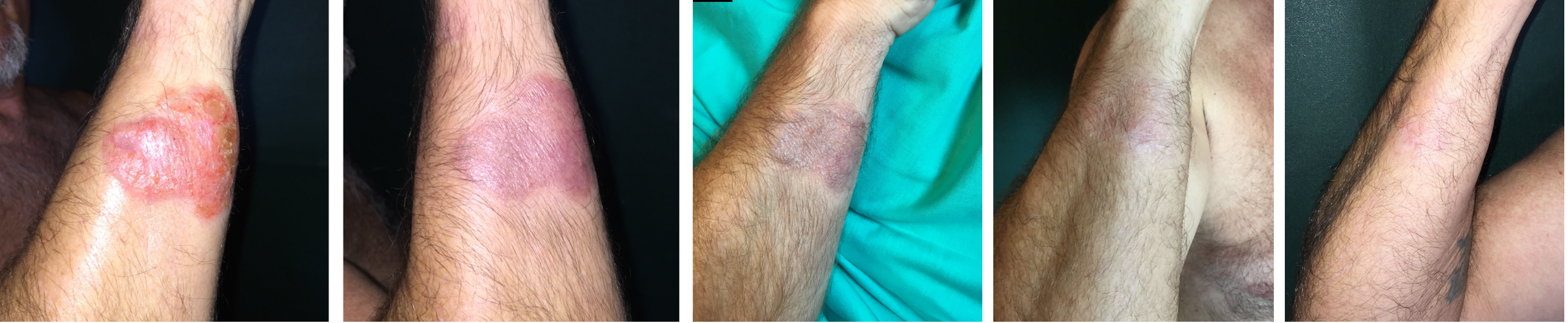 La crema que reduce el riesgo del cáncer de piel La crema que reduce el riesgo del cáncer de piel