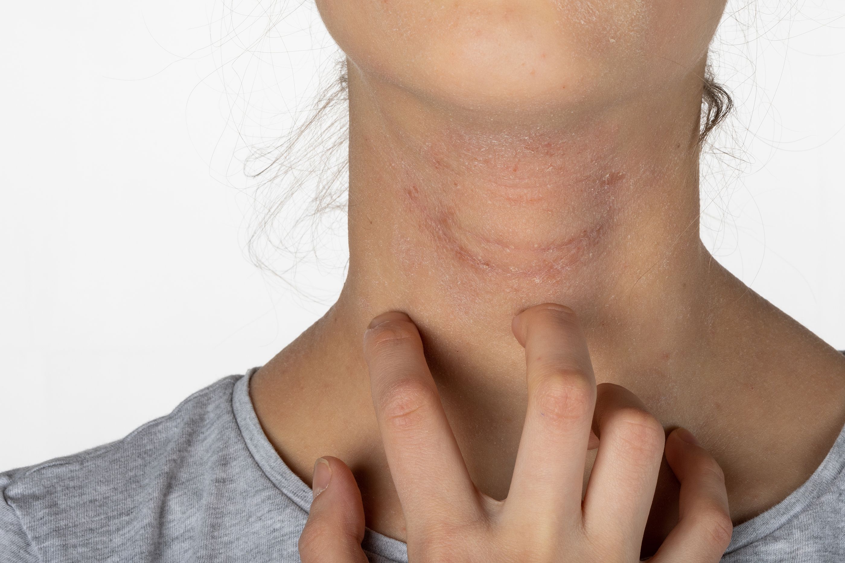 Cómo evitar la dermatits atópica por sudor 