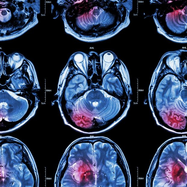 Encuentran un fármaco para el tumor cerebral más frecuente y agresivo Encuentran un fármaco para el tumor cerebral más frecuente y agresivo