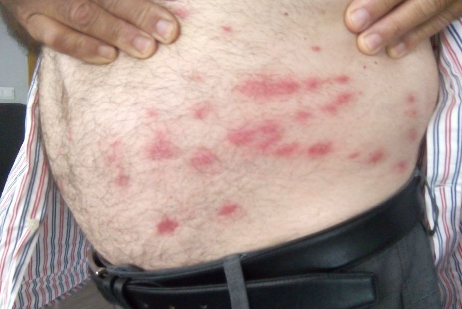 Picadura de mosca negra