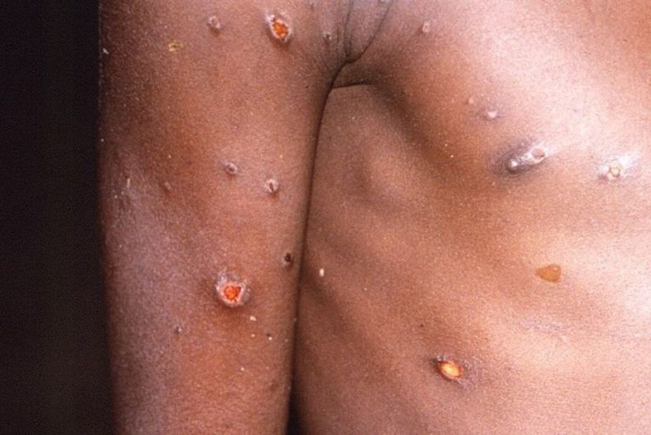 4 de cada 10 infectados con viruela del mono tienen complicaciones y necesitan tratamiento