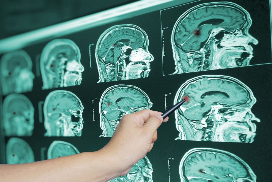 'Superneuronas' contra el alzhéimer 'Superneuronas' contra el alzhéimer