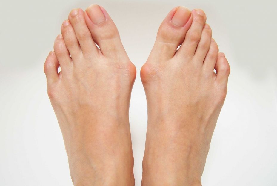 Operación de juanetes Operación de juanetes