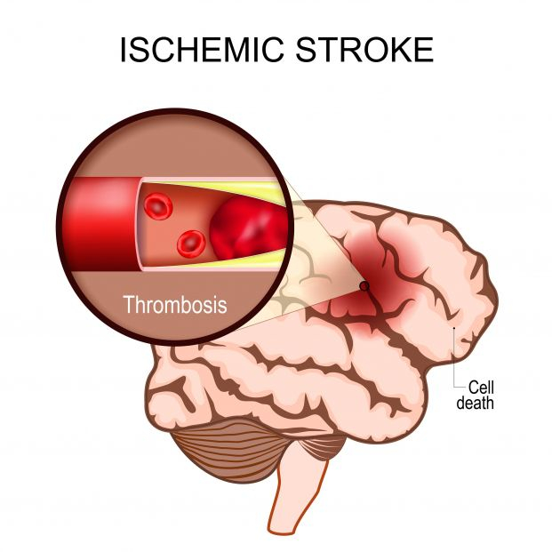 bigstock Ischemic Stroke Human Brain461375049 bigstock Ischemic Stroke Human Brain461375049