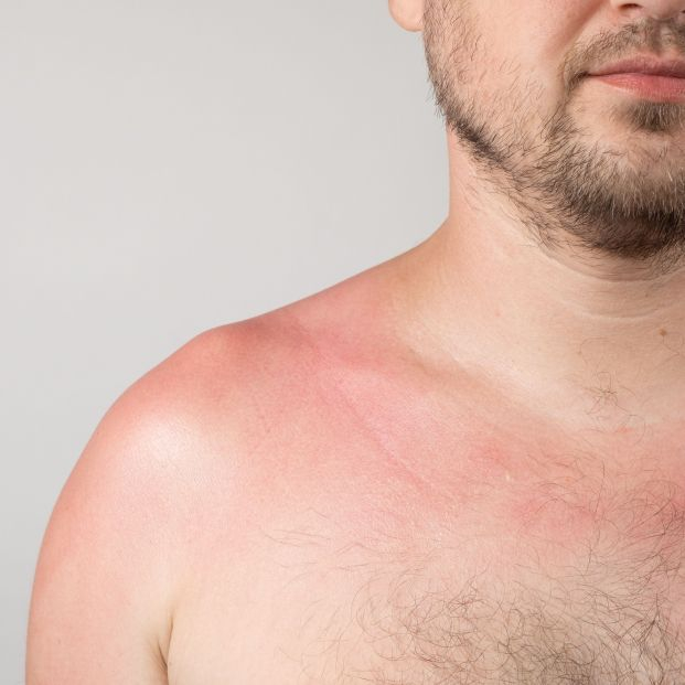 bigstock Skin Of A Person With Sunburn463460195