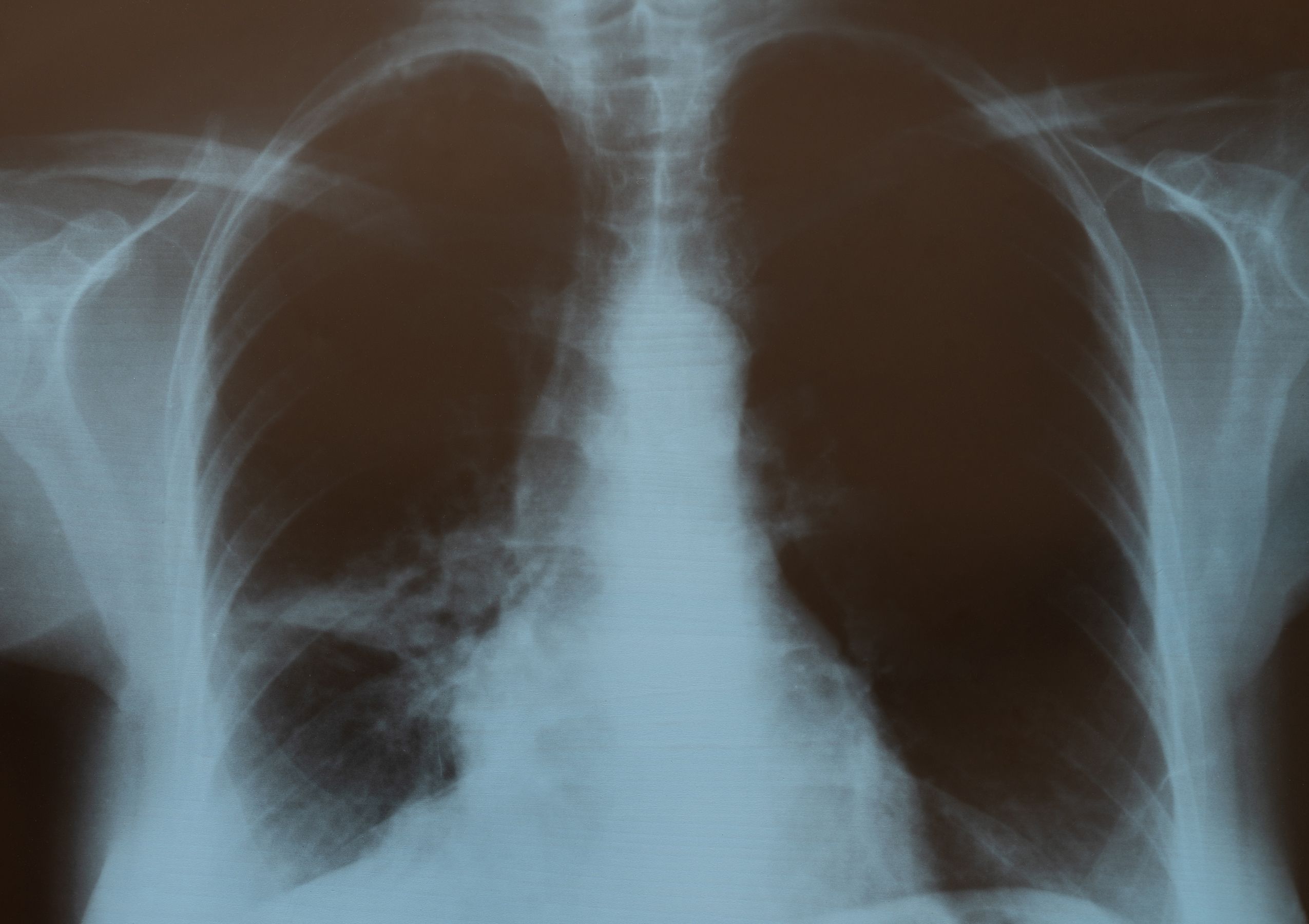 Crean una 'píldora viva' para combatir infecciones pulmonares resistentes a antibióticos