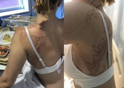 Ingresada tras la picadura de una carabela portuguesa en Murcia Ingresada tras la picadura de una carabela portuguesa en Murcia