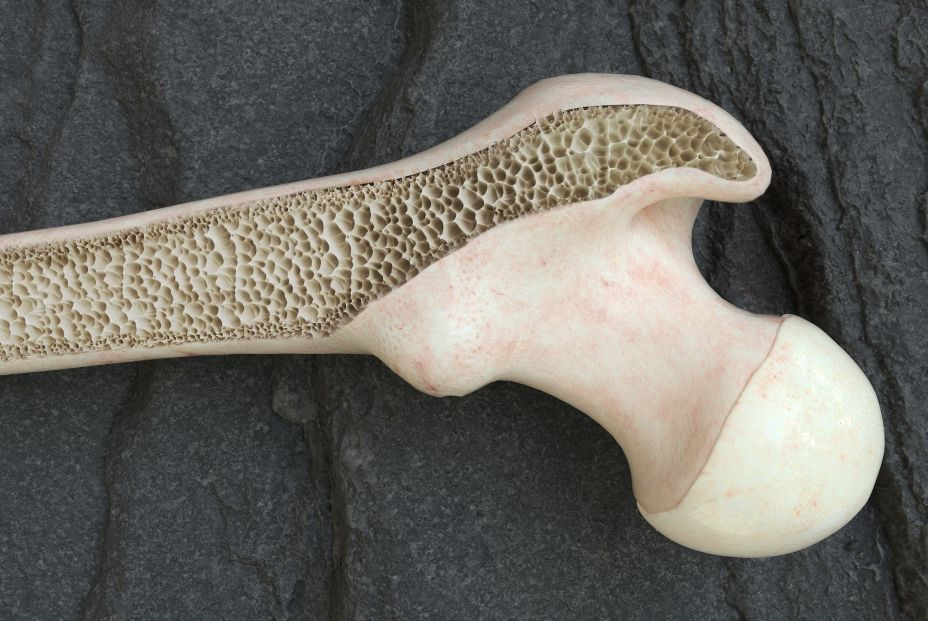 Esta es la dieta recomendada para reducir el riesgo de fracturas en pacientes con osteoporosis