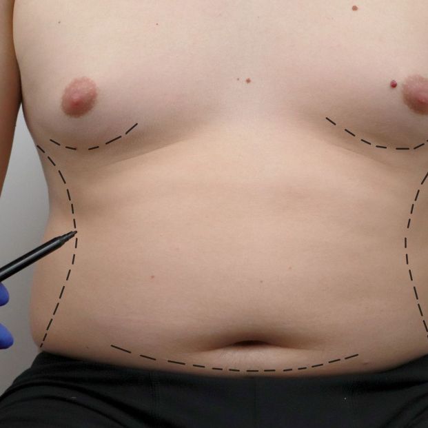 Ginecomastia operación Ginecomastia operación