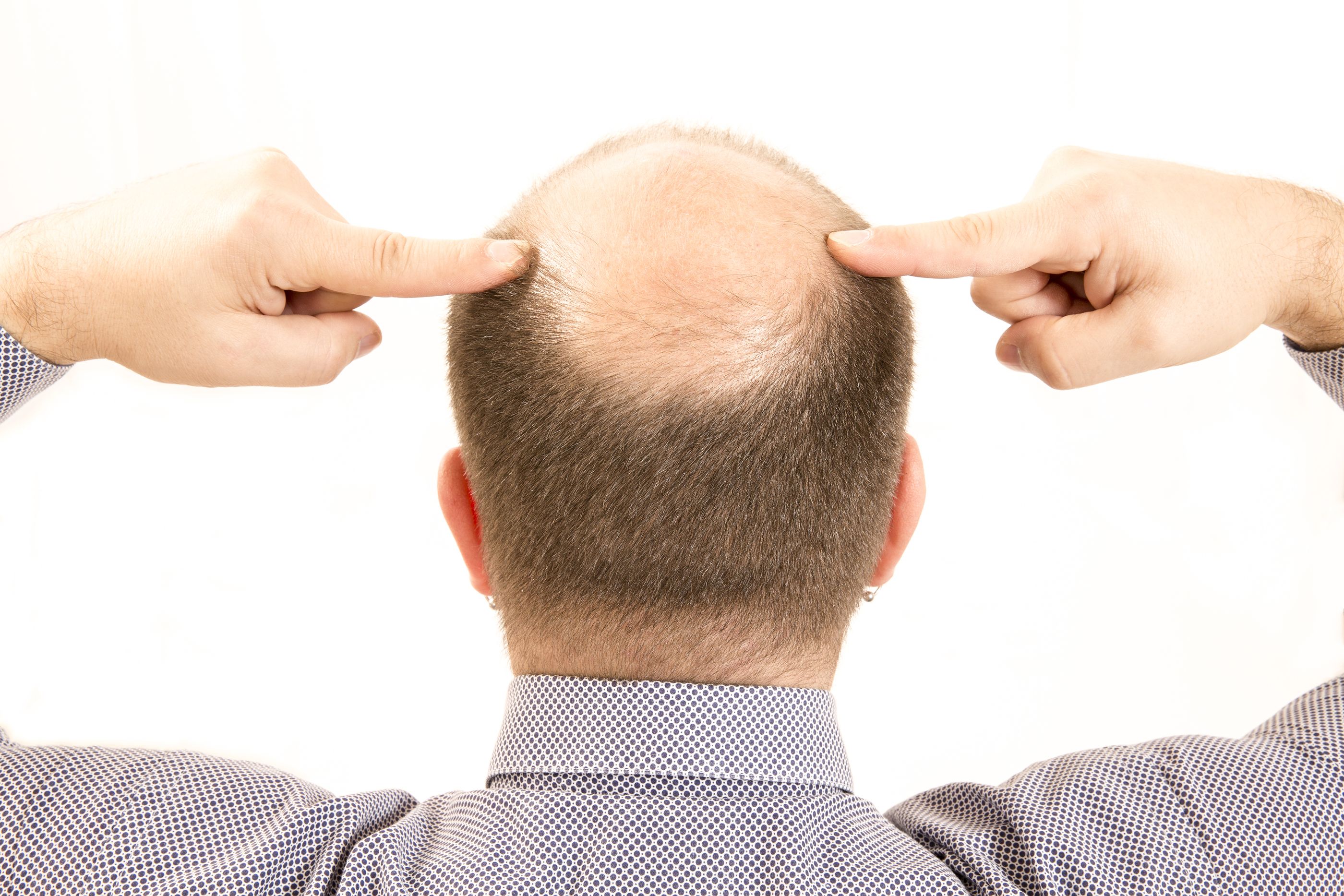 ¿Adiós a la calvicie?: Consiguen que crezca pelo usando células madres