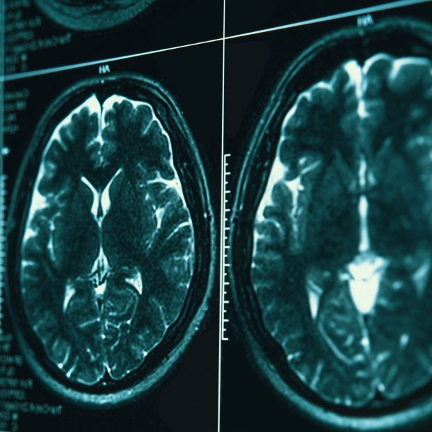 La incidencia del párkinson "se triplicará en España en los próximos 30 años" La incidencia del párkinson "se triplicará en España en los próximos 30 años"
