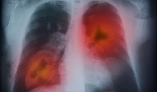 Un biomarcador permite saber si un tratamiento de cáncer de pulmón funciona