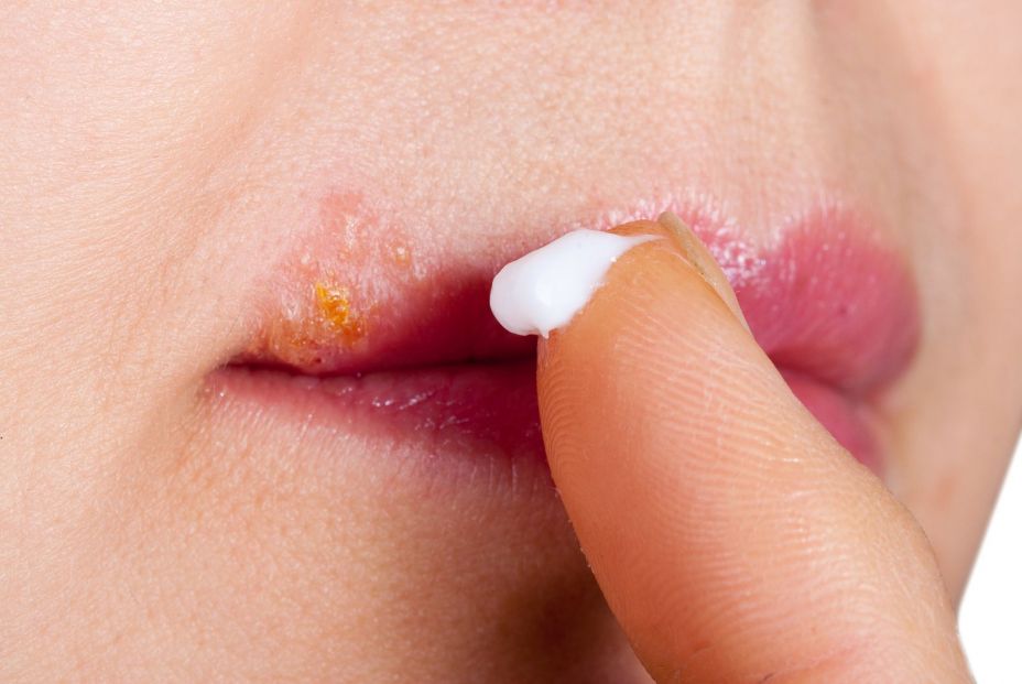 Herpes labial Herpes labial