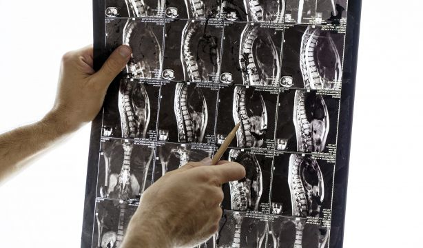 Muere de cáncer de pulmón después de acudir 26 veces al médico, y que le diagnosticaran lumbalgia