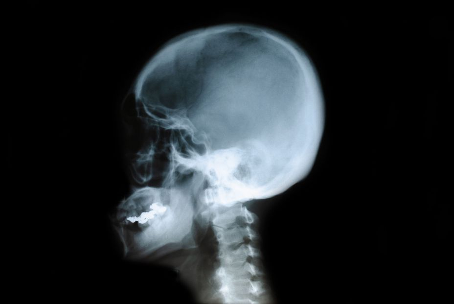 bigstock X ray Film Of The Head Child429068828 bigstock X ray Film Of The Head Child429068828