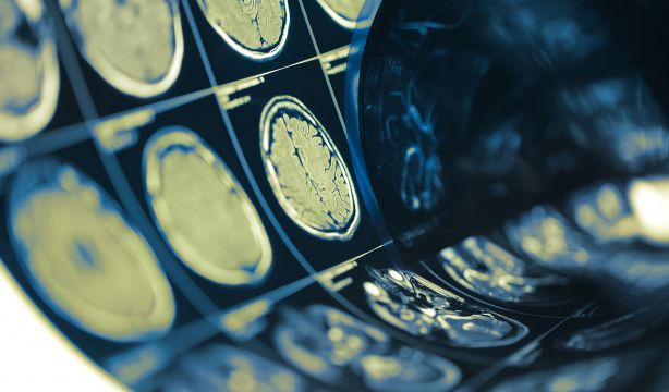 La inteligencia artificial logra predecir la genética de tumores cerebrales en menos de 90 segundos. Foto: Bigstock