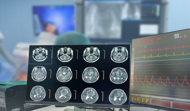 Crean un fármaco en gel que detiene los tumores cerebrales en ratones