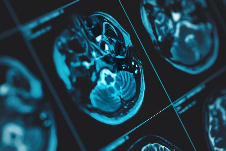 bigstock Mri Scan Of Human Head Close u 400642313