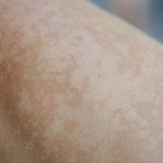 Un estudio señala que un componente de la melanina es "clave" en la protección solar