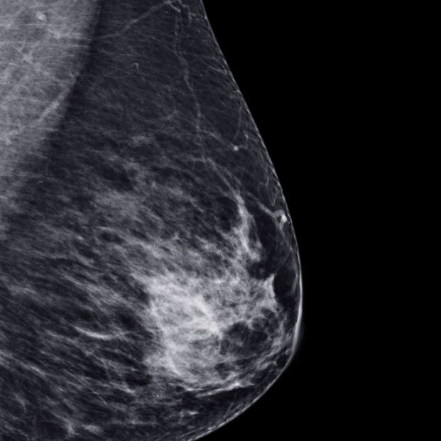 Los expertos apuestan por aumentar el cribado de cáncer de mama hasta los 74 años