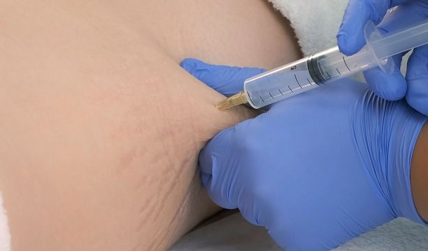 Ozonoterapia qué es y para qué se utiliza