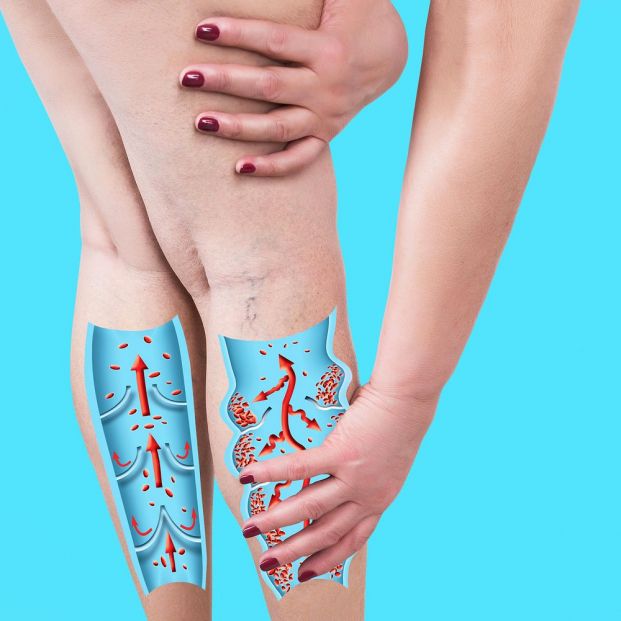 Ejercicios Buerguer Allen Insuficiencia venosa Ejercicios Buerguer Allen Insuficiencia venosa