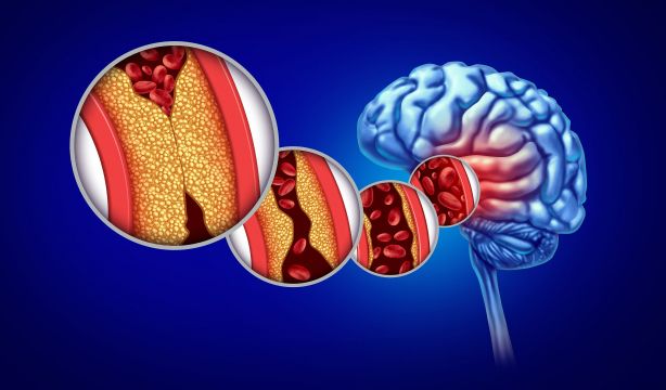 ¿Hay relación entre el colesterol y el riesgo de demencia?