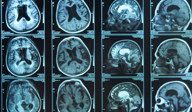Un nuevo estudio ayuda a un mejor diagnósticos del Alzheimer con el uso de técnicas de imagen médica