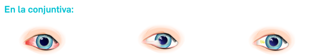 Daños en la conjuntiva Daños en la conjuntiva