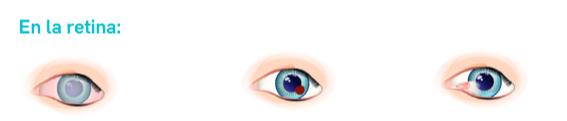 Daños en la retina Daños en la retina