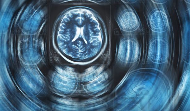 España, un país puntero en investigar el alzhéimer: sexto del mundo y tercero de Europa