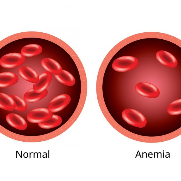 Anemia