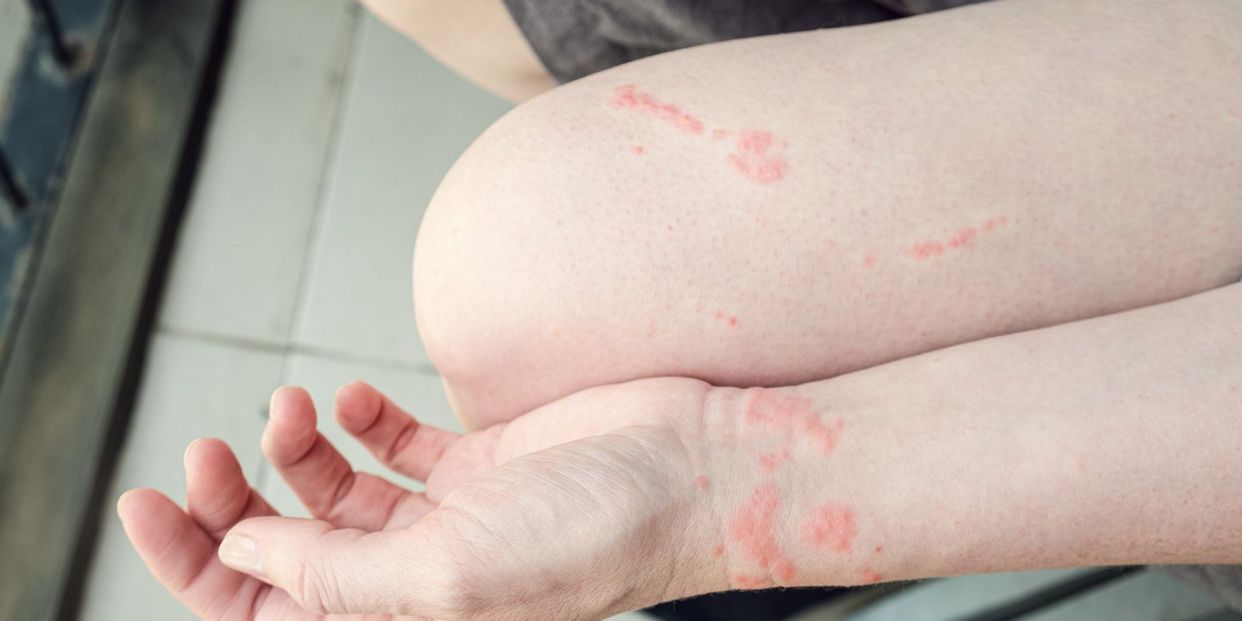 ¿Cómo debemos actuar ante una picadura de medusa?