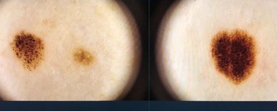 Un fármaco contra dolencias cardíacas mejora la eficacia de las terapias frente al melanoma Un fármaco contra dolencias cardíacas mejora la eficacia de las terapias frente al melanoma