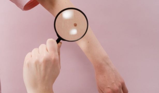 Golpe al melanoma: se podrá diagnosticar de forma temprana mediante biopsia líquida