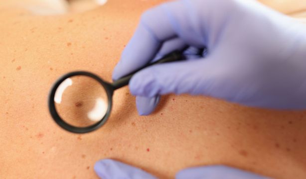 Fármacos de inmunoterapia ayudan a prolongar la vida de pacientes con melanoma metastásico
