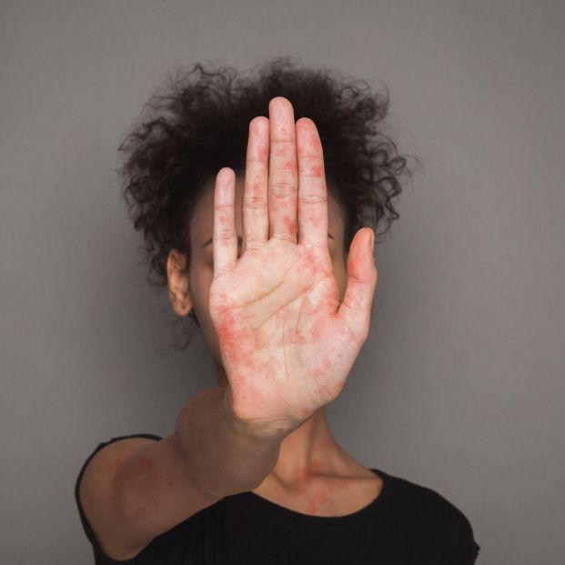 Mano con llagas a casusa del sarampión