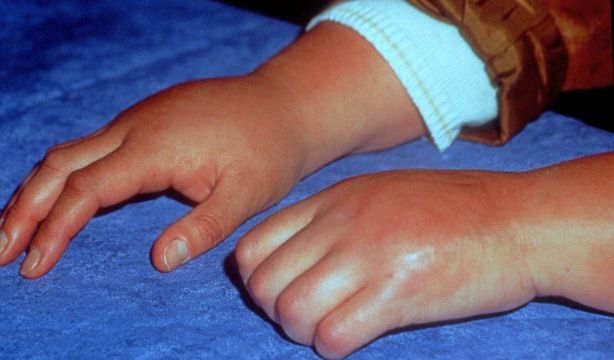 Sudeck o síndrome del dolor regional complejo