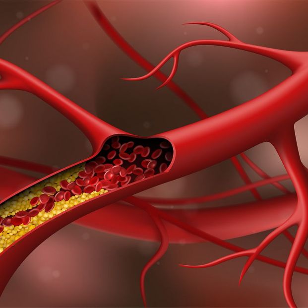 Descubre la relación entre el colesterol y los riesgos de padecer demencia