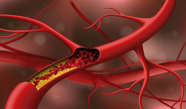 Los análisis pueden ser insuficientes para pacientes con colesterol: esta es la razón