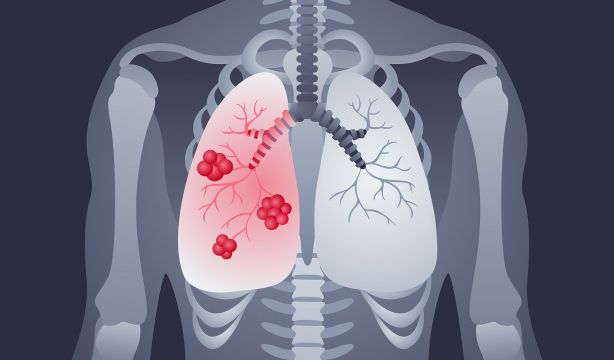 Identifican un gen que potencia la inmunoterapia en el cáncer de pulmón más agresivo al inhibirse