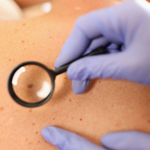 Una de cada tres muertes por cáncer de piel no melanoma se debe al trabajo bajo el sol