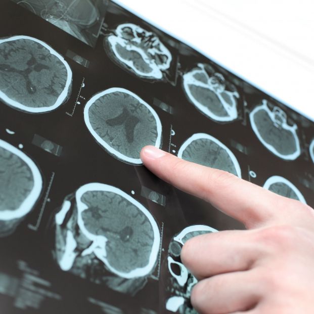 Hallazgo histórico: descubren que existen cinco tipos de alzhéimer Hallazgo histórico: descubren que existen cinco tipos de alzhéimer