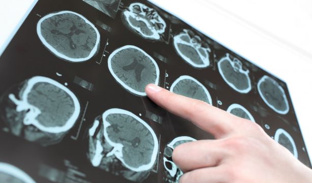 Hallazgo histórico: descubren que existen cinco tipos de alzhéimer