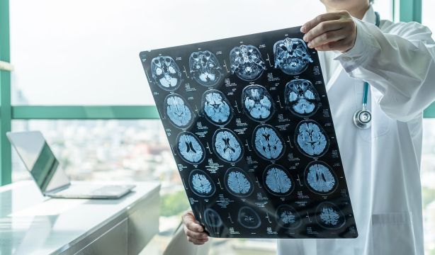Un estudio muestra cómo afecta la acumulación de dos proteínas a los pacientes con alzhéimer (bigstock)