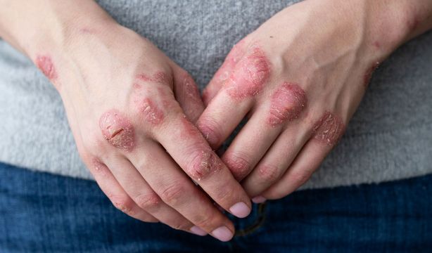 Nuevos avances para la psoriasis permiten la remisión completa en la mitad de los casos