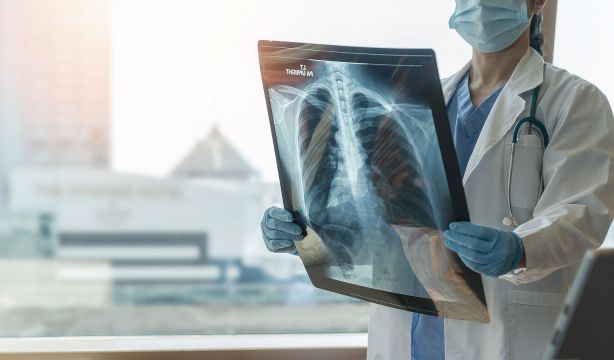 Descubren una posible diana terapéutica contra la hipertensión pulmonar