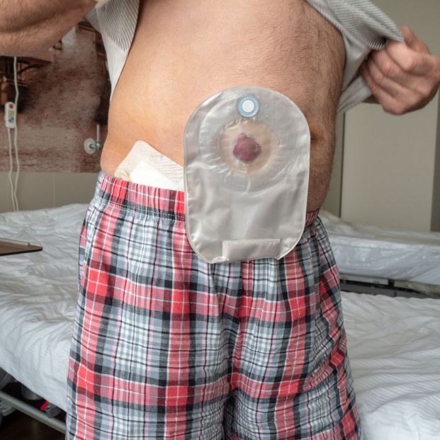 Ostomía Ostomía