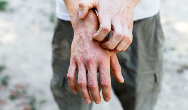 El uso excesivo de calefacción puede empeorar la dermatitis atópica (Bigstock)